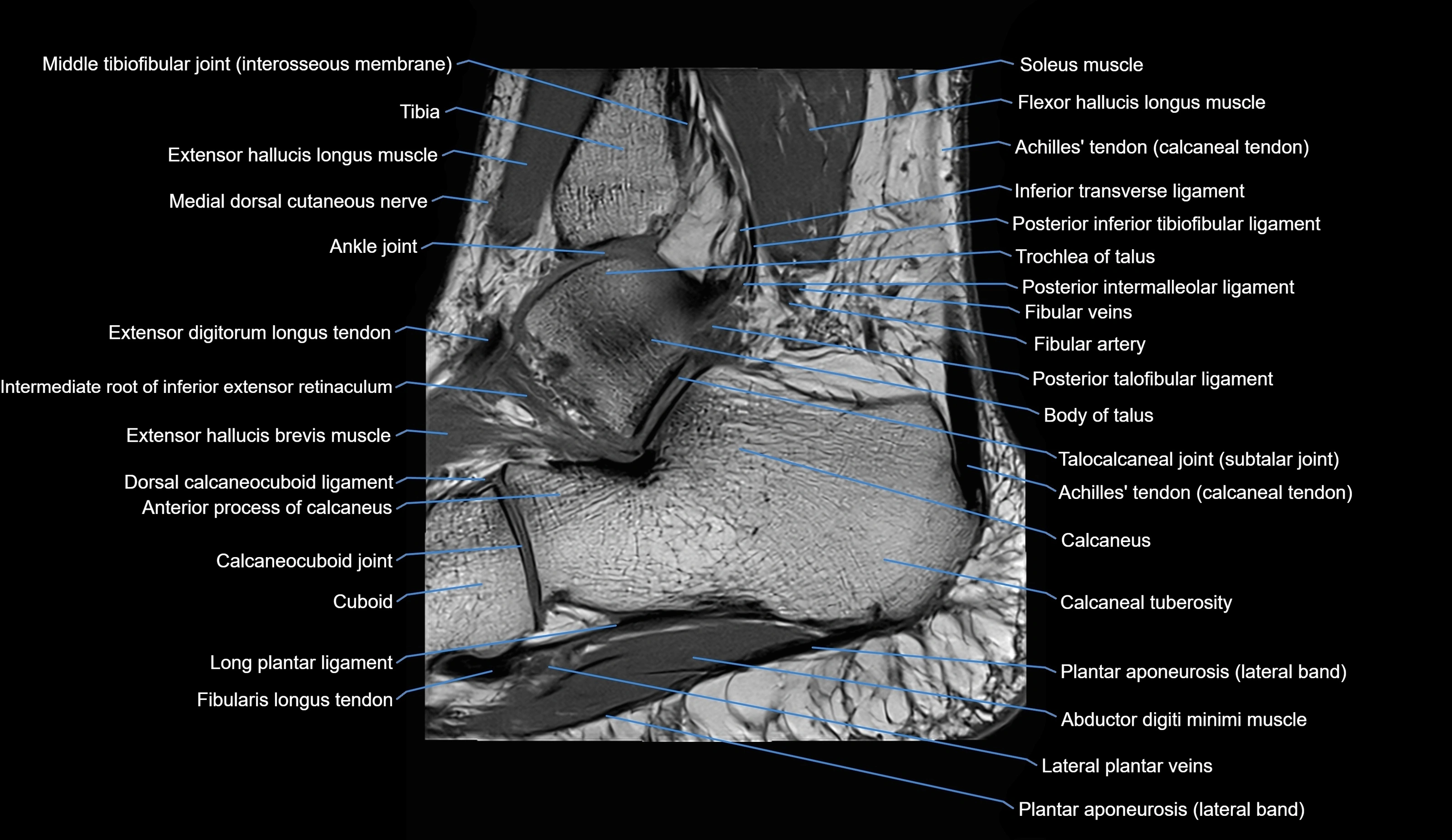 MRI Ankle sagittal cross sectional anatomy 3T  radiology  image-img-00001-00024.webp